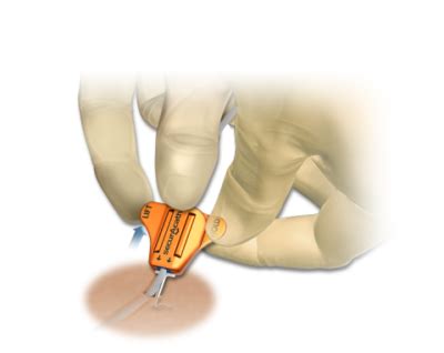 Placement & Removal Procedures - SecurAcath