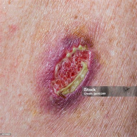 Dehisced Wound Stock Photo - Download Image Now - Wound, Basal Cell ...