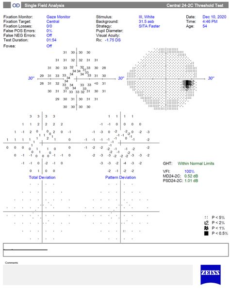 Breaking Down Visual Fields in Glaucoma