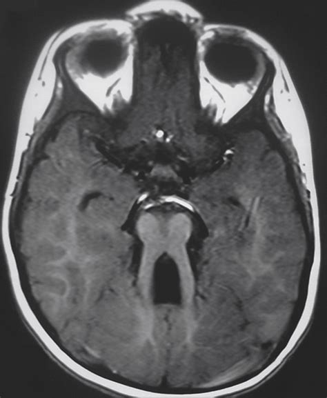 The Molar Tooth Sign of Joubert Syndrome | JAMA Neurology | JAMA Network