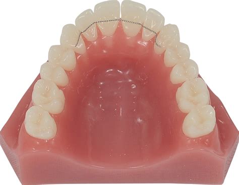 Bonded Retainers | Thermadent Orthodontic Laboratory