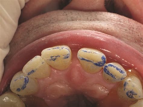 Show Your Work: Treating Incisal Edge Wear by Dr. Marvin Fier - Dentaltown