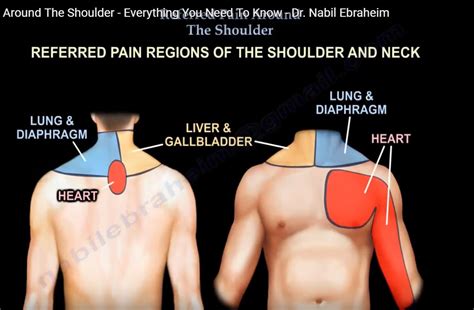 Referred pain around the Shoulder — OrthopaedicPrinciples.com