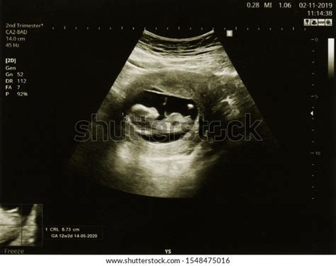 Ultrasound 3 Weeks: Over 31 Royalty-Free Licensable Stock Photos ...