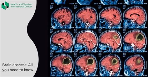 Brain abscess - methods of diagnosis and treatment - HTI CENTERS | Medical Tourism Center