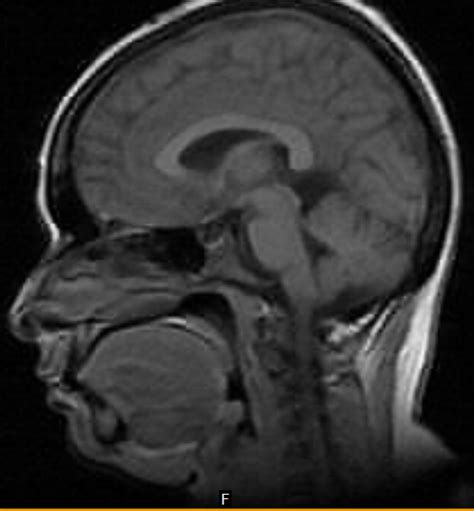 Idiopathic intracranial hypertension-MRI - Sumer's Radiology Blog