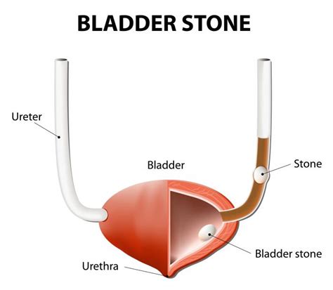 Bladder Stones: Causes, Symptoms, and Treatments