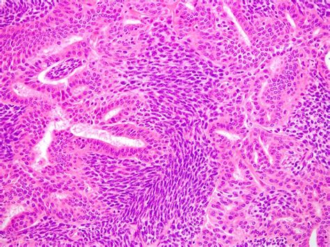 Synovial Sarcoma Histology