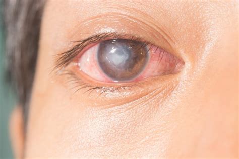 Viral Eye Infection: Types, Symptoms, Treatment | STD.GOV Blog