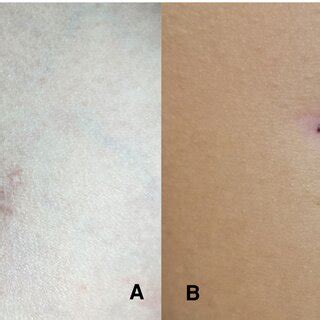 (A) Healing status of the wound with the conventional method 6 months... | Download Scientific ...