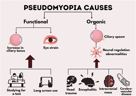 Cureus | Pseudomyopia and Its Association With Anxiety