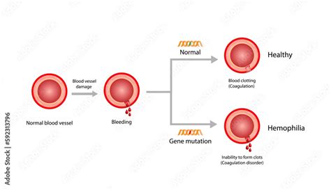 Hemophilia, a bleeding disorder that slows the blood clotting. Haemophilia (Coagulation disorder ...