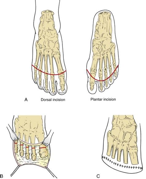 Lower Extremity Amputation | Thoracic Key