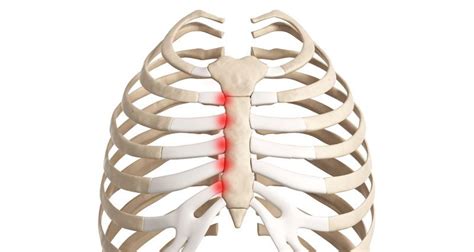 Costochondritis (Tietze's Syndrome) - Sportsinjuryclinic.net