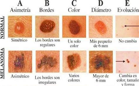 Revisión bibliográfica: melanoma - Ocronos - Editorial Científico-Técnica