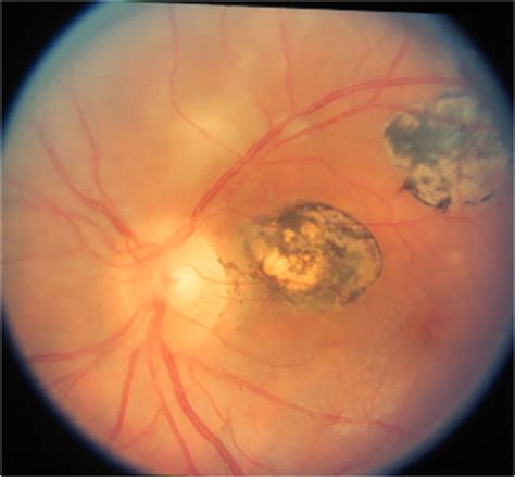 Uveitis, Uveitis Eye - Causes, Types, Symptoms, Diagnosis, Treatment