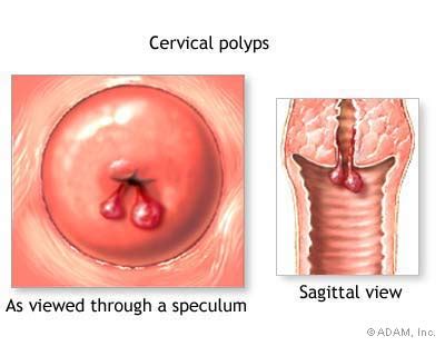 The New York Times > Health > Image > Cervical Polyps