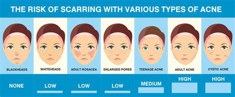 Types of Acne Scars: Pictures, Diagnosis and Treatments