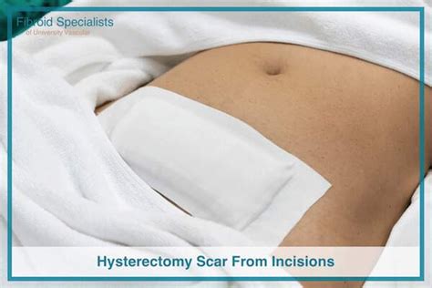 Hysterectomy Scar From Incisions with Pictures | Fibroid Specialists