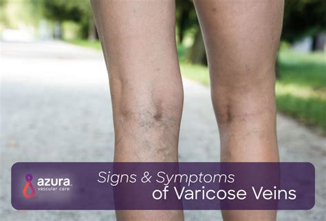 Signs & Symptoms of Varicose Veins | Azura Vascular Care