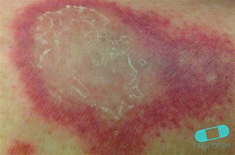 vasculitis rash - pictures, photos