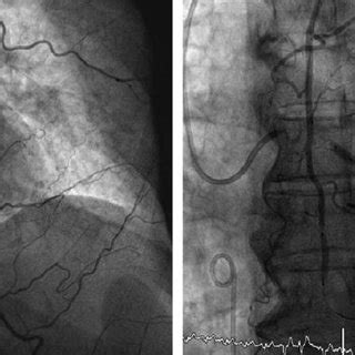 Left internal mammary artery (LIMA) angiographies in a patient before... | Download Scientific ...