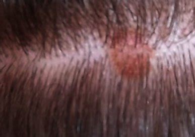 Painful Pimples on Scalp: Causes, Treatment and Prevention