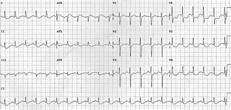 Myocardial Ischaemia • LITFL • ECG Library Diagnosis