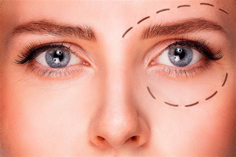 Ptosis Correction or Droopy Eye Lid Surgery | Hong Plastic Surgery Clinic