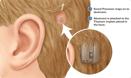 Baha Implant