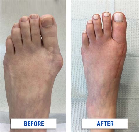 After Your Bunion Surgery - Alpine Foot Specialists