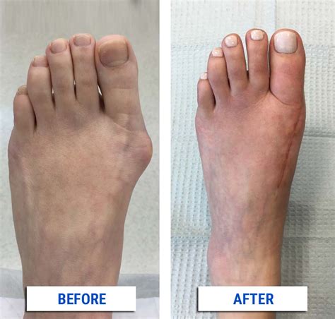 After Your Bunion Surgery - Alpine Foot Specialists