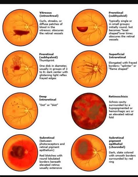 Findings on Fundus... - Ophthalmology-Notes And Synopses | Facebook