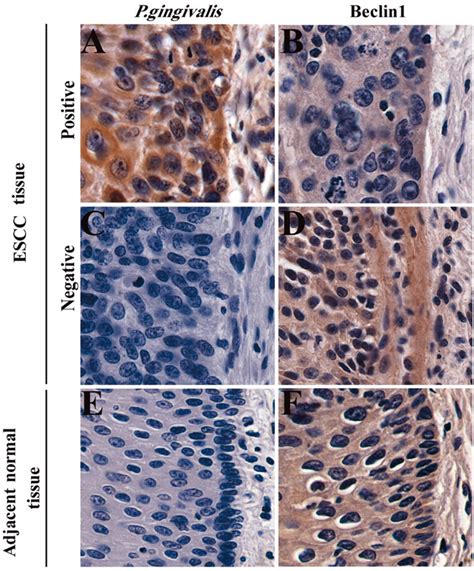 POR | Associations of Porphyromonas gingivalis Infection and Low Beclin1 Expression With ...