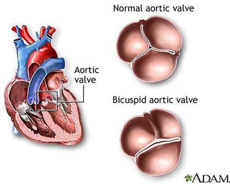 Pictures Of Aortic Valve