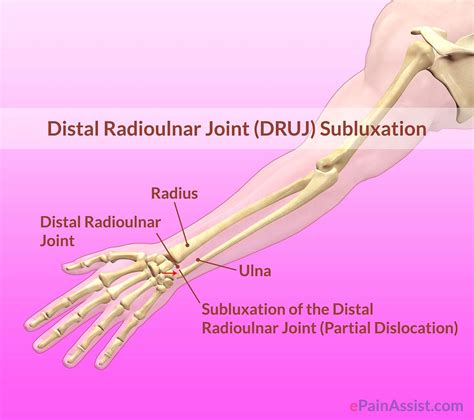 Distal Radioulnar Joint (DRUJ) Subluxation