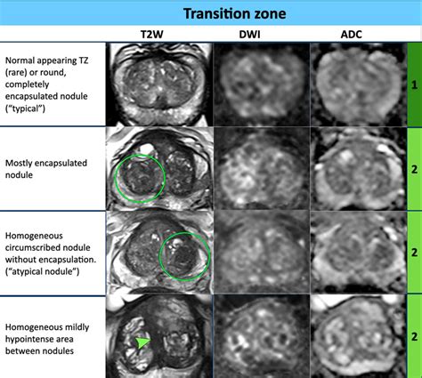 The Radiology Assistant : Prostate Cancer - PI-RADS v2.1