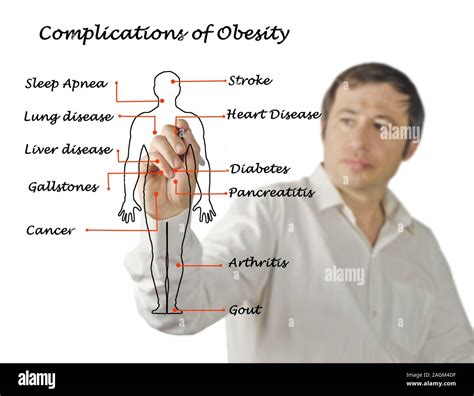 Complications of Obesity Stock Photo - Alamy