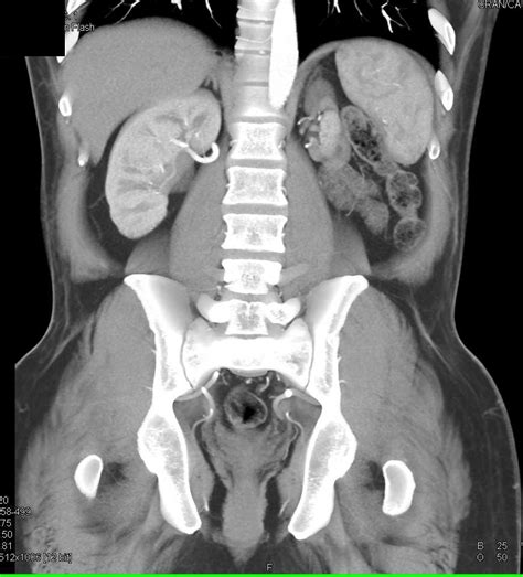 Atrophic Left Kidney - Kidney Case Studies - CTisus CT Scanning