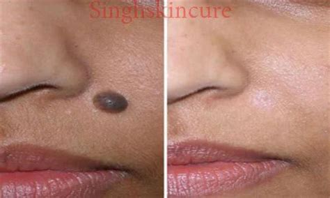 Moles Skin Treatment Service at best price in Noida | ID: 15967267930