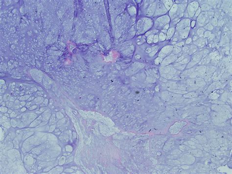 Chondrosarcoma - Pathology - Orthobullets