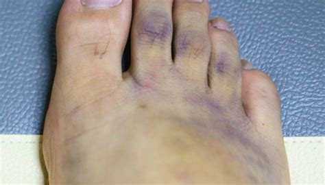 Purple feet: Causes and treatment