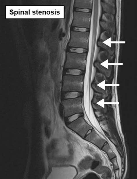 Diagnosis of Spinal Stenosis - PT Master Guide