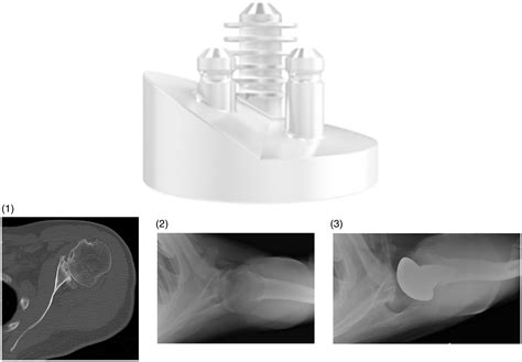 Anatomic Augmented Glenoid Implants for the Management of the B2 Glenoid - Lisa GM Friedman ...