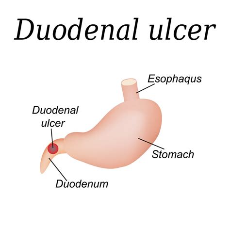 Duodenal Ulcer : Overview, Causes, Symptoms, Treatment - illness.com