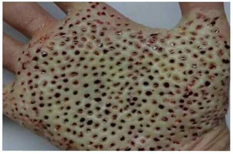 Trypophobia: Symptoms, Causes, Treatment