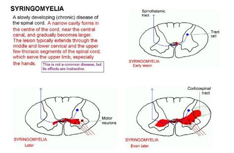 syringomyelia Symptoms and Treatment – Mediologiest