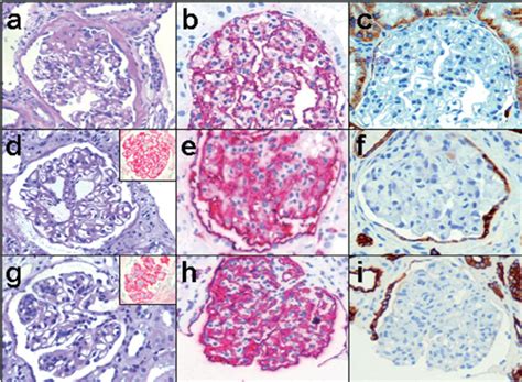 PAS, podocalyxin and CK8–18 staining in corresponding kidney biopsies... | Download Scientific ...