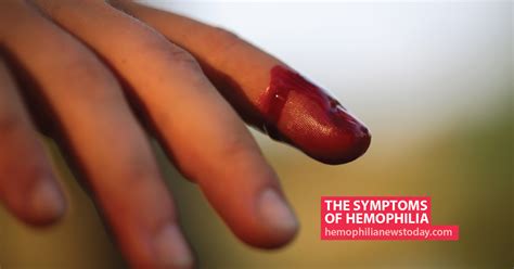 The Symptoms of Hemophilia | Hemophilia News Today