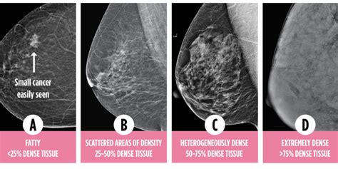 Home | Dense Breasts Canada | Breast Density Matters.